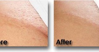cera_wax's tweet photo. Do you suffer from #IngrowingHairs ? 
We now offer #BikiniFacials £20 #manchestercity #Manchester #bury #deals https://t.co/lVCCtOOtlU