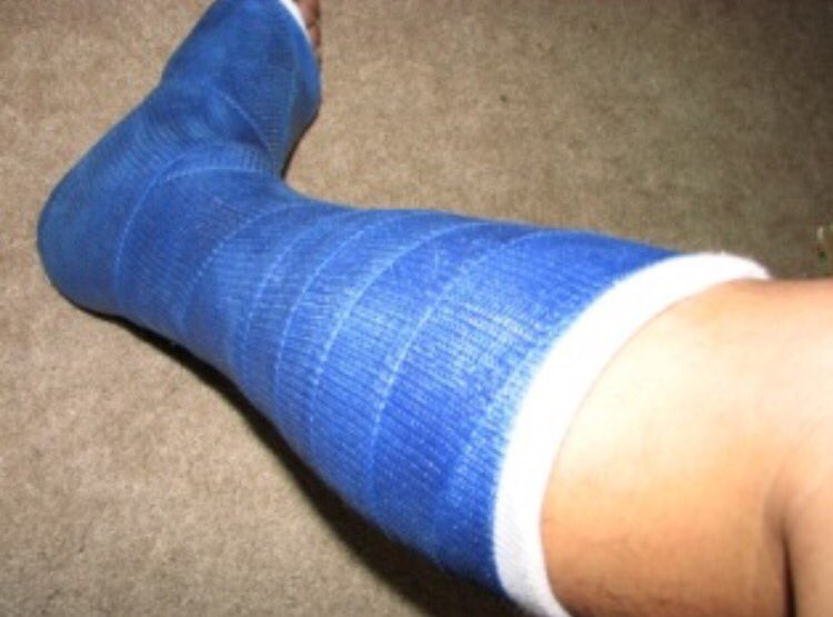 Bailey Byrne When Ur Mom Sends A Pic Of Her Foot In A Cast As An April Fools Joke But Then Actually Breaks Her Foot 2 Weeks Later T Co Dz2nz9vrr9