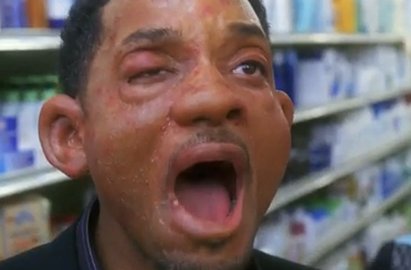 KiddNation's tweet photo. Oh no! Poor @bigalmack's eyes are so swollen and looks like Hitch! Guess he's a stay at home mom today. https://t.co/gUCB8W0wGZ