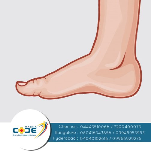 #Happyfeet #footcare Specialize treatments &amp; Examination of your #foot diseases by MagnaCode expert team.