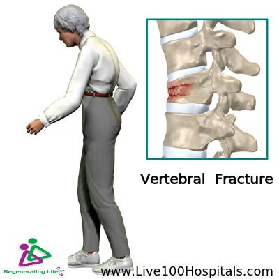 Live100Health's tweet photo. We are the Most #Reliable and dedicated center to effectively solve #VertebralFracture. https://t.co/N9wZoI48I7