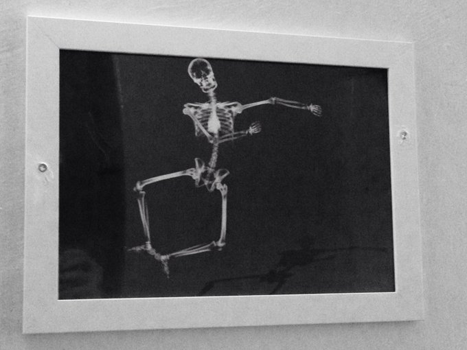 If you are seeing this, it means I survived the #tonsillectomy surgery :-) https://t.co/0gvI8VIfNt<a href="/tag/tonsillectomy"class="tags"><span>#tonsillectomy</span></a>