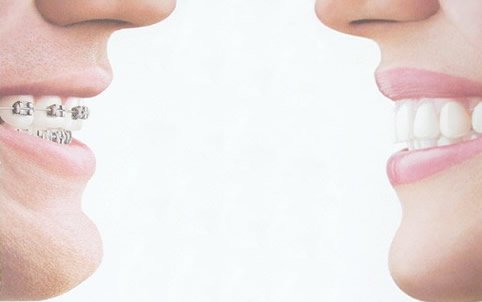 Técnicas de Ortodoncia: Convencional VS Lingual
covadongabalaguer.es/tecnicas-de-or…