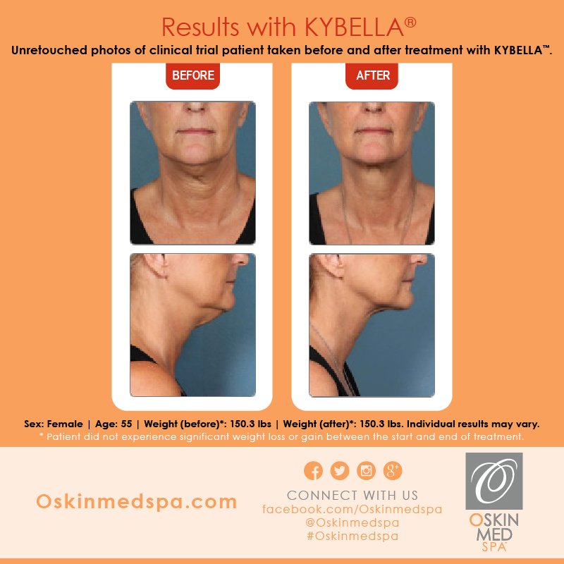 OskinMedSpa's tweet photo. Before &amp; After #Kybella #OSkinMedSpa #Skincare #Spa #Relax #HealthySkin #BodyTreatments #FacialTreatments https://t.co/eYtZjX5QIo