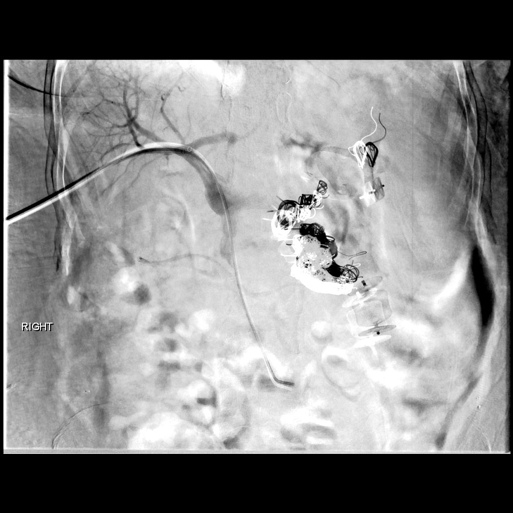 porto-systemic shunt- trans-hepatic access- 2 hrs,43 coils,2 plugs- <a href="/SIRRFS/">SIR RFS</a> #irad #foamir #kitchensink #emptyshelves