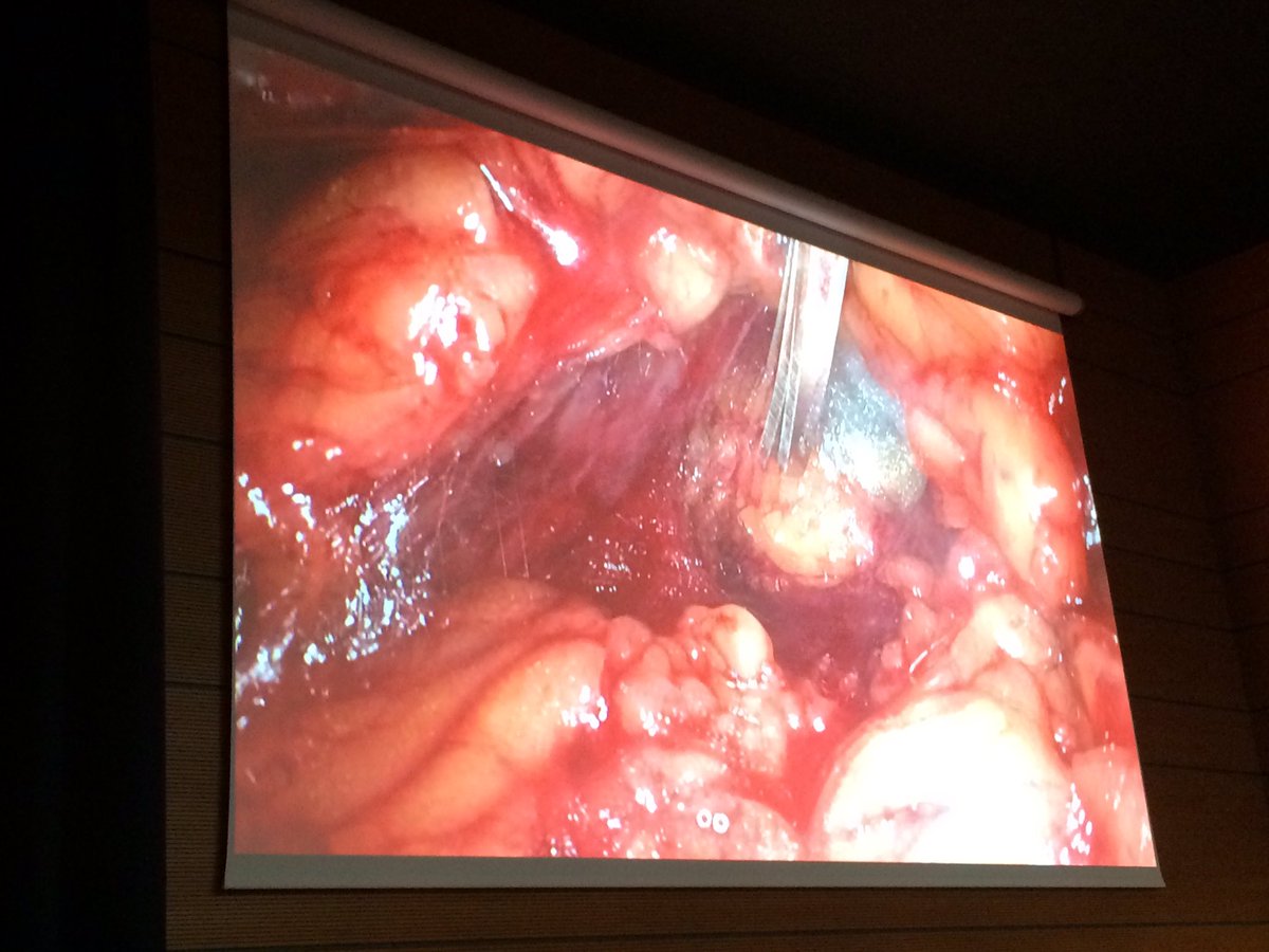 JParlinska's tweet photo. How can we improve partial #nephrectomy with #smartglass #AugmentedReality #surgery #3d #lifesurgery @SmartglassExp https://t.co/uzIIj54jY6