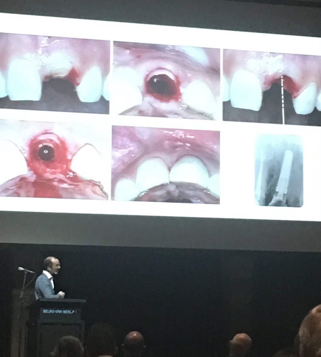 BluemOralCare's tweet image. another great #hockey player @HaakonKuit #nvoi presenting #socketpreservation #Dr MarkusHuerzeler @BeursVanBerlage