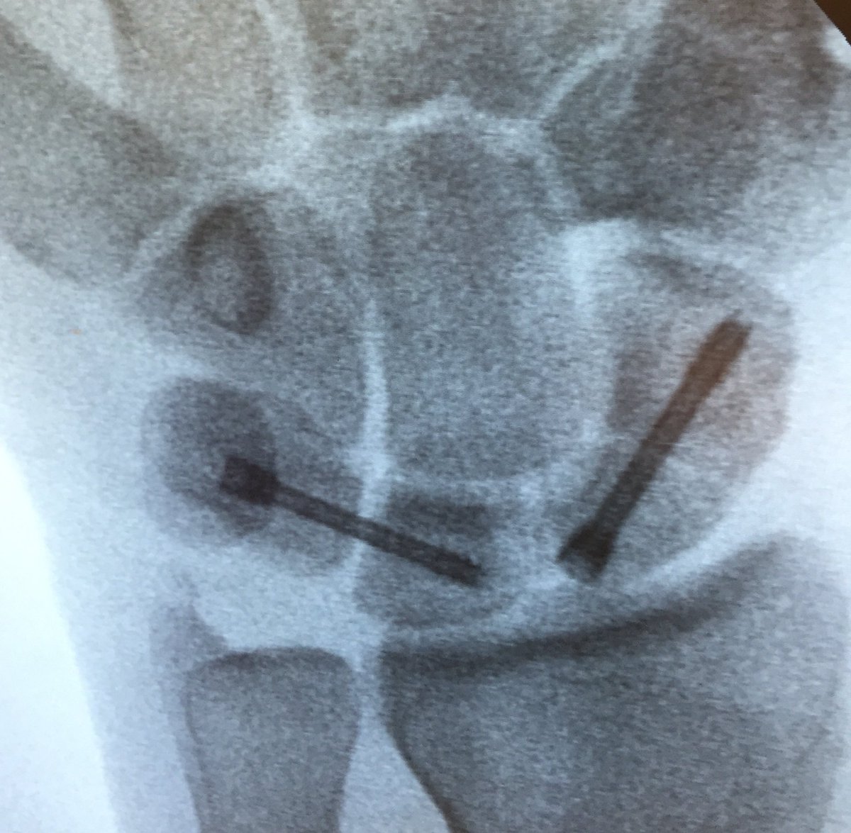 After 8 weeks back on it! Thanks <a href="/mike_hayton/">Mike Hayton</a>, @TheRealConehead and the <a href="/_physio_/">Harris & Ross Physio</a> for getting me back on track!