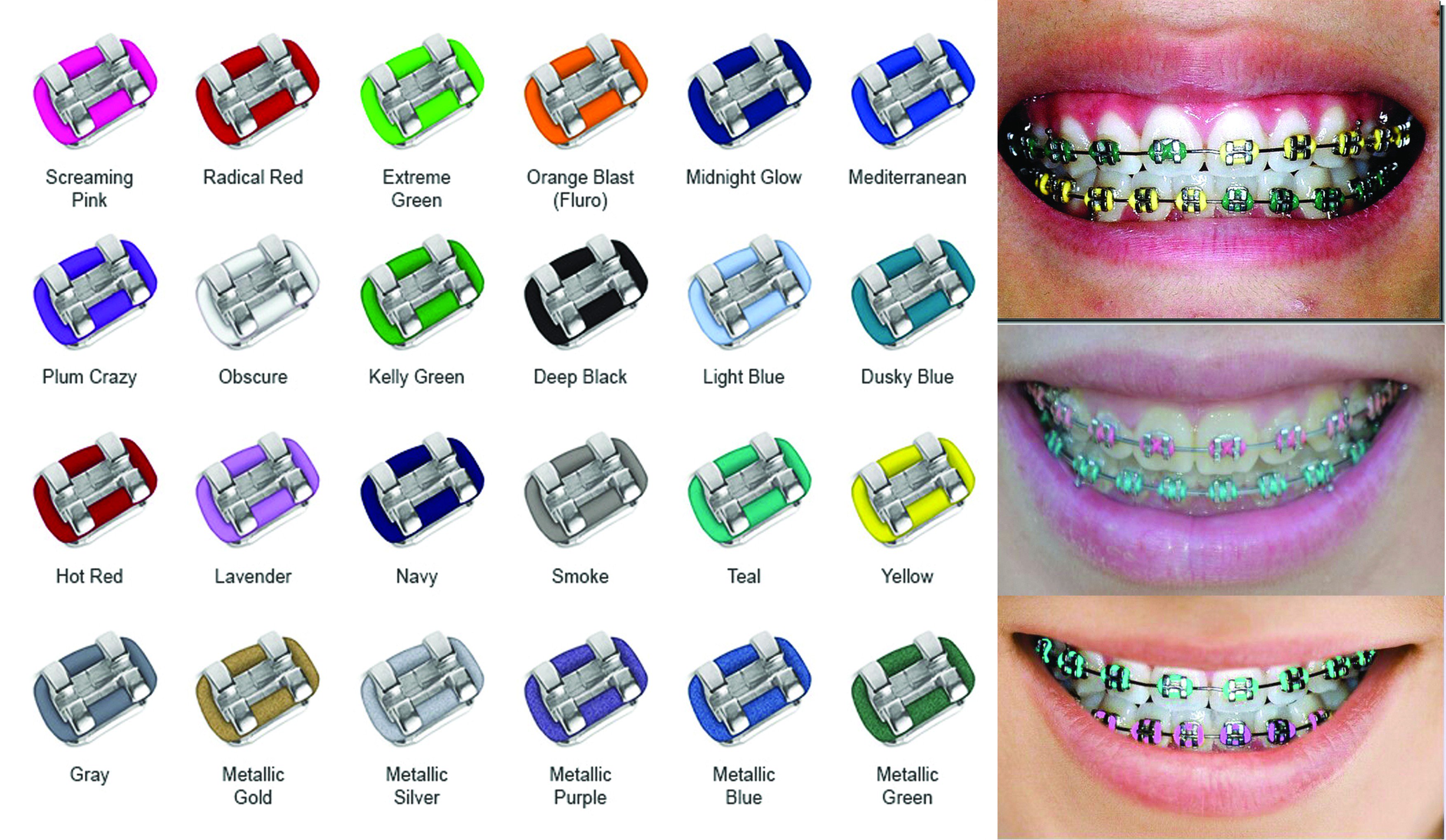 Lime 2024 green braces