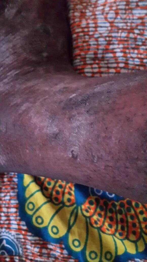 He needs a liver transplant, this is life &amp; death. Pls do your bit and pls spread the word gofundme.com/hjx4jfwc