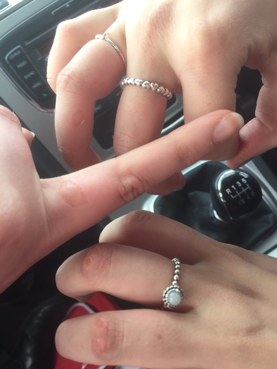RosieKyrkeSmith's tweet photo. Who knew that PomPom blisters were a thing? @KittyC2411 and I have obtained them from dancing at the #readinghalf! https://t.co/zv3ua4YAEF