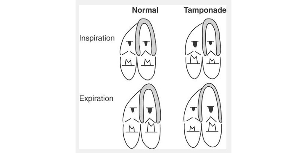 This pic explaining doppler flow in tamponade seems annoyed that it has tamponade. 

(Doppler flow = annoyed eyes)