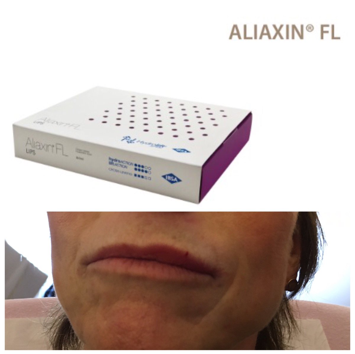 ha_dermauk's tweet photo. Half done, half to go... One very happy model... @DrIrfanMian #lipmasterclass #IBSA #Aliaxin https://t.co/NotJUOmZ5u