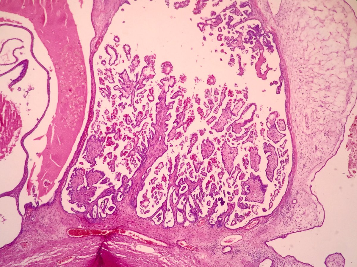 solcosao's tweet photo. 53yo, ovarian borderline serous papillary tumor with hyaline globules #pathologist #gynpath #ovariantumors https://t.co/h1RvcQbpVv