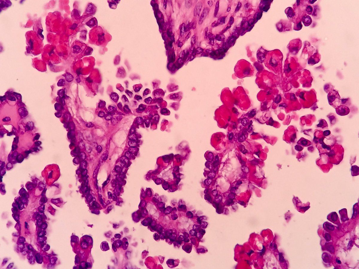 solcosao's tweet photo. 53yo, ovarian borderline serous papillary tumor with hyaline globules #pathologist #gynpath #ovariantumors https://t.co/h1RvcQbpVv