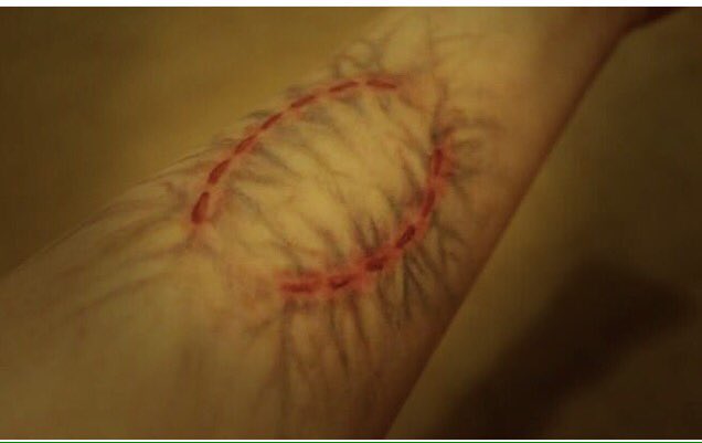 Zombie bite infection, #zombie #infection #bite #sfx #sfxmakeup #specialeffects #fx #specialeffectsmakeup #makeup