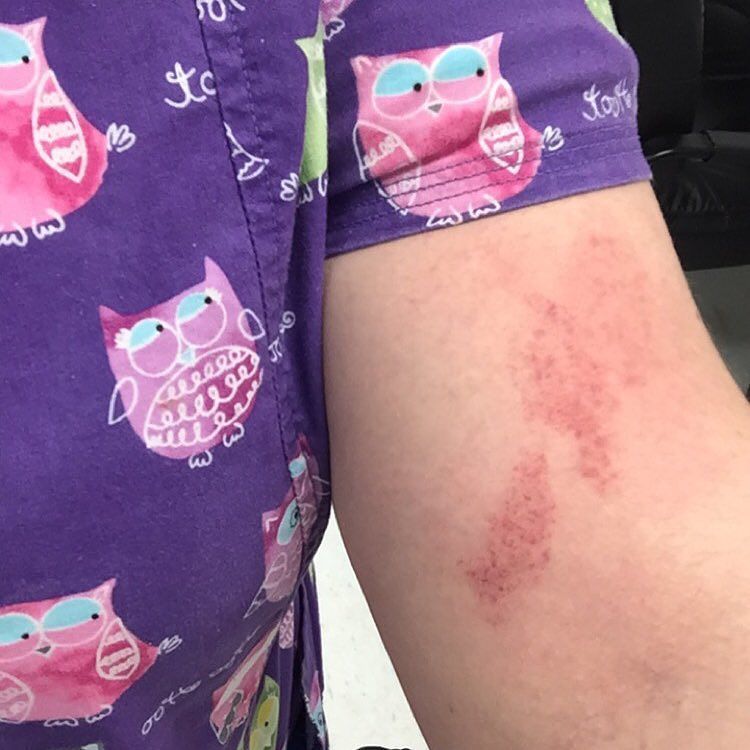 TheCaringTimes_'s tweet photo. #truelife "I'm a #cna"
#CNA #cnalife #yeahithurts #beatup #bruises #proudcna #scrubs #scrublife #nursinghomelife #… https://t.co/og6oFnfqon