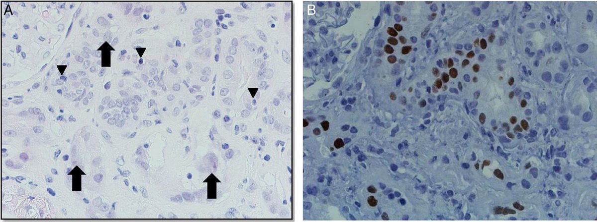CKJsocial's tweet photo. BK #polyoma virus infection and #renal disease in non-renal solid organ #transplantation https://t.co/OQU5pc49bX https://t.co/AOaqG4otNz