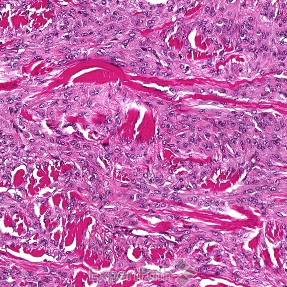 DavidStockmanMD's tweet photo. #pathquiz Pseudomyogenic #Hemangioendothelioma #pathology pitfall4 DF #dermpath #bstpath #dermatology #pathologists https://t.co/J6PscWZOua