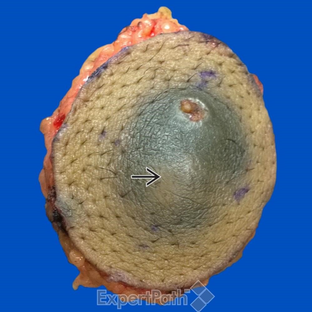DavidStockmanMD's tweet photo. #pathquiz Pseudomyogenic #Hemangioendothelioma #pathology pitfall4 DF #dermpath #bstpath #dermatology #pathologists https://t.co/J6PscWZOua