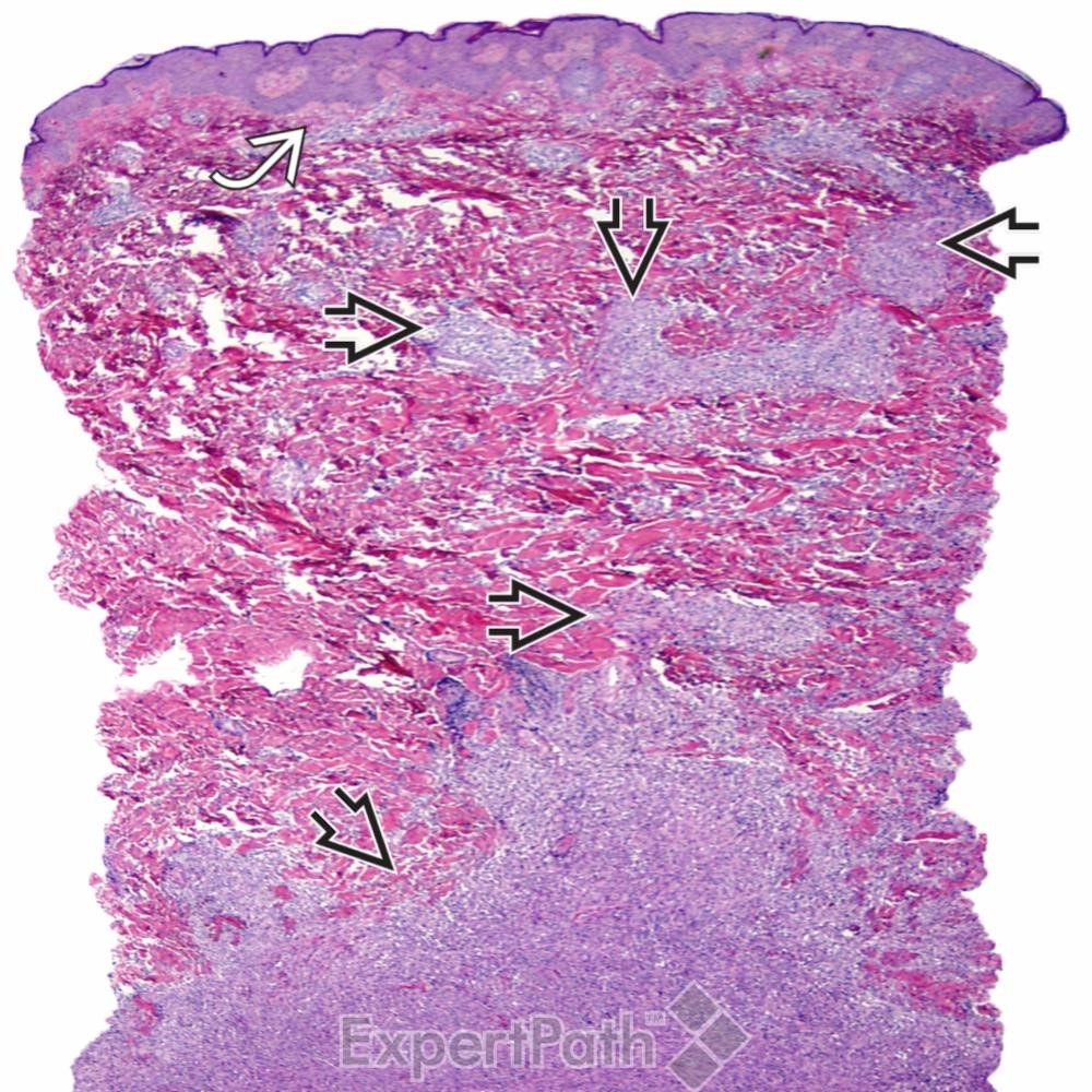 DavidStockmanMD's tweet photo. #pathquiz Pseudomyogenic #Hemangioendothelioma #pathology pitfall4 DF #dermpath #bstpath #dermatology #pathologists https://t.co/J6PscWZOua