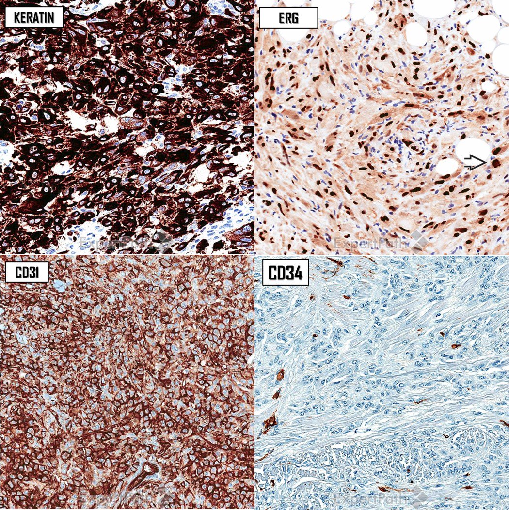 DavidStockmanMD's tweet photo. #pathquiz Pseudomyogenic #Hemangioendothelioma #pathology pitfall4 DF #dermpath #bstpath #dermatology #pathologists https://t.co/J6PscWZOua
