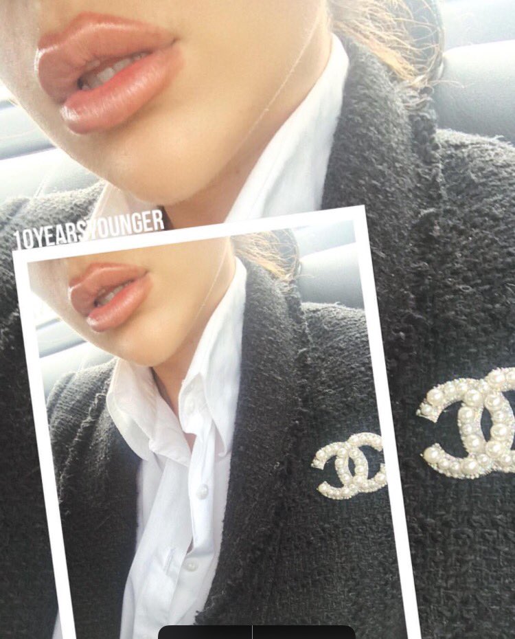 Lip enhancement by <a href="/10yearsyoungerr/">10 YEARS YOUNGER</a> 💋💉 For all prices and information, please contact 07437079697 📞