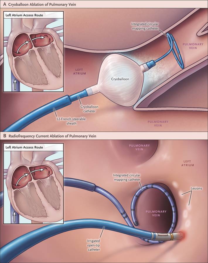 NEJM's tweet photo. #ACC16: Cryoballoon or Radiofrequency Ablation for Paroxysmal Atrial Fibrillation. https://t.co/ug81AUpGpk https://t.co/527MjEBSHE