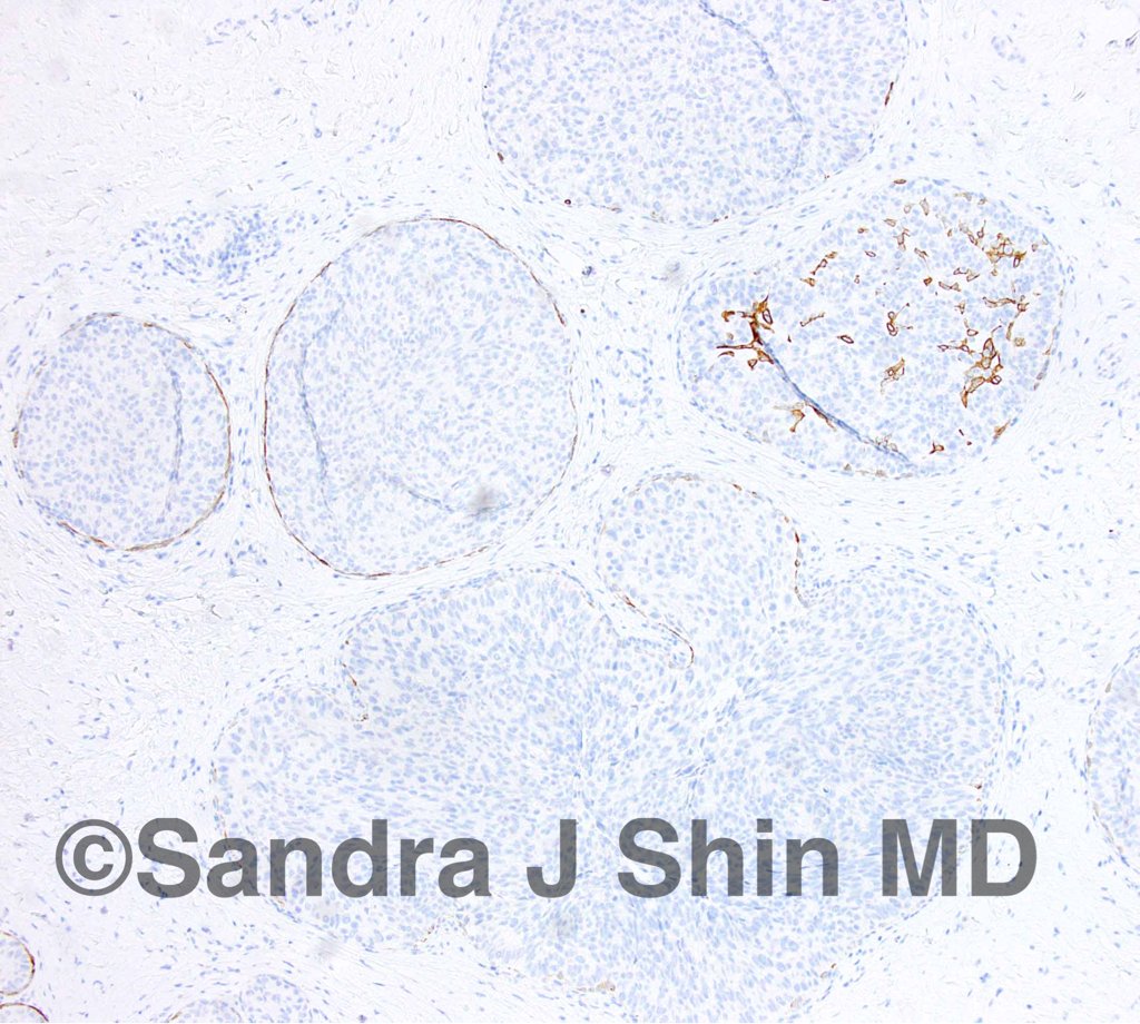 Sandra J Shin Md Mba Dcis With Spindle Cell Morphology Negative Ck 5 6 Helps To Distinguish From Florid Usual Ductal Hyperplasia T Co Vfclbmz3o3