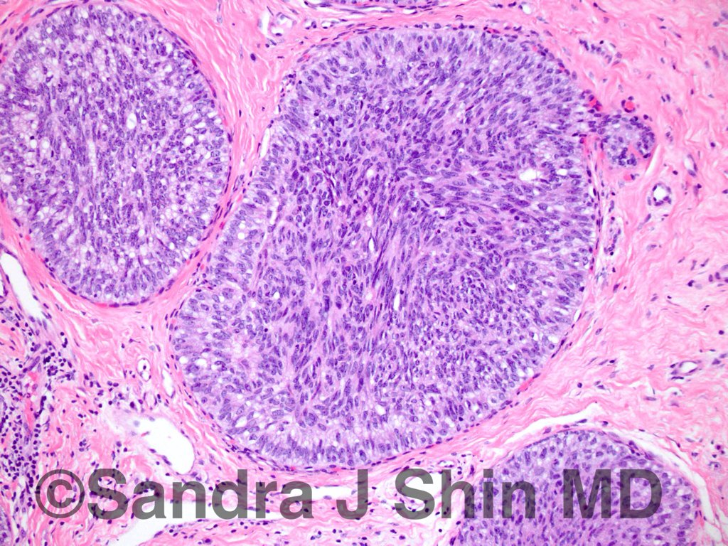 Sandra J Shin Md Mba Dcis With Spindle Cell Morphology Negative Ck 5 6 Helps To Distinguish From Florid Usual Ductal Hyperplasia T Co Vfclbmz3o3