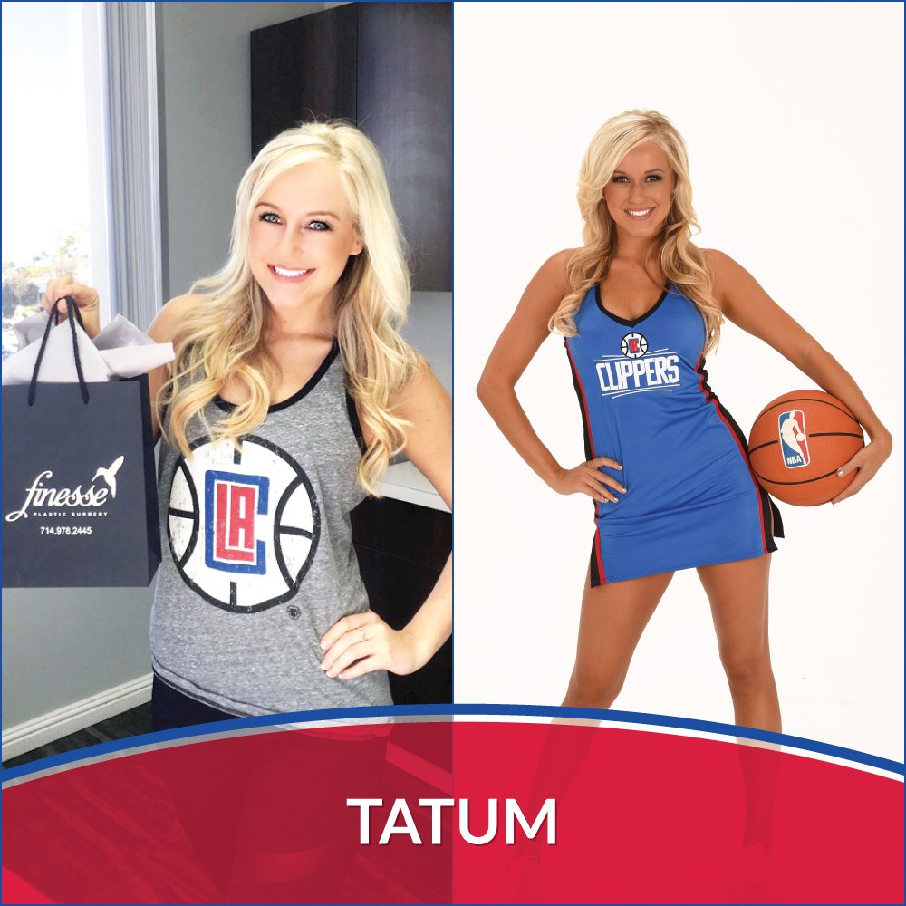 FinessePS's tweet photo. #LAClippersSpirit dancer @Tatum_Dumont visited Finesse #NewportBeach for #laserhairremoval #LADCS #LAClippers #Laser https://t.co/VuRmWWgAg8