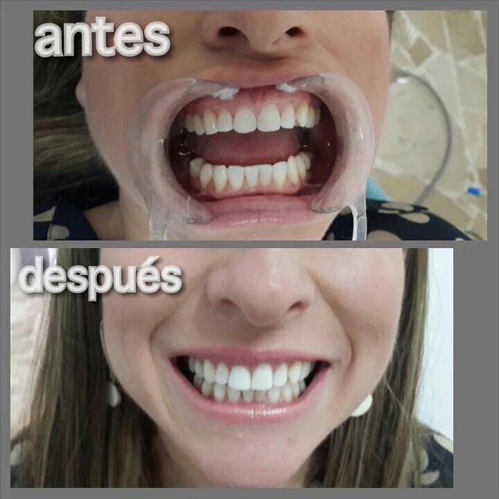 WorldSteticGye's tweet photo. Diseña tu sonrisa con carillas de resina en @WorldSteticGye del @DrPeterValverde ☎6027410 consulta GRATUITA. #Urdesa https://t.co/hWd8HhWBDl