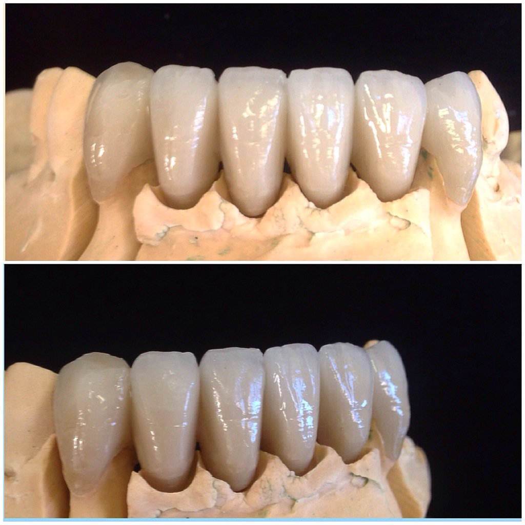 DSDdentallab's tweet photo. 3-3 Layered Zirconia Bridge with scanned Zirconia framework 👍#zirconia #scanned #bridge #dental #dentisty https://t.co/RDpjFd3BnE