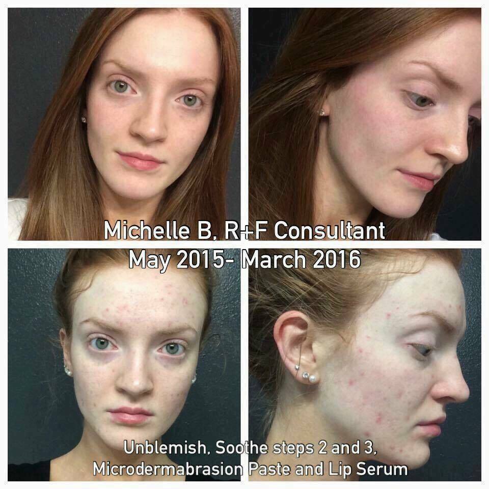 back2simple's tweet image. These results speak for themselves!!! 

 Are you ready to have your OWN RESULTS?!!??
#unblemishchangesskin #RFworks