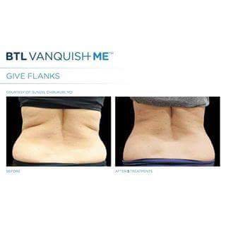 BTLAestheticsUK's tweet photo. #TravelTuesday Feel and look your best with #VanquishME - #lookdifferentfeeldifferent https://t.co/84vxcyPCl7