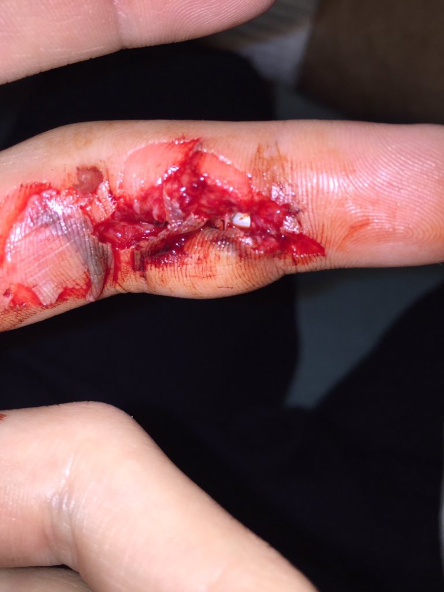 injurypics's tweet photo. Weights do damage https://t.co/0Tjt0vWTVG