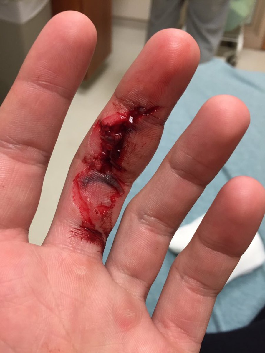 injurypics's tweet photo. Weights do damage https://t.co/0Tjt0vWTVG