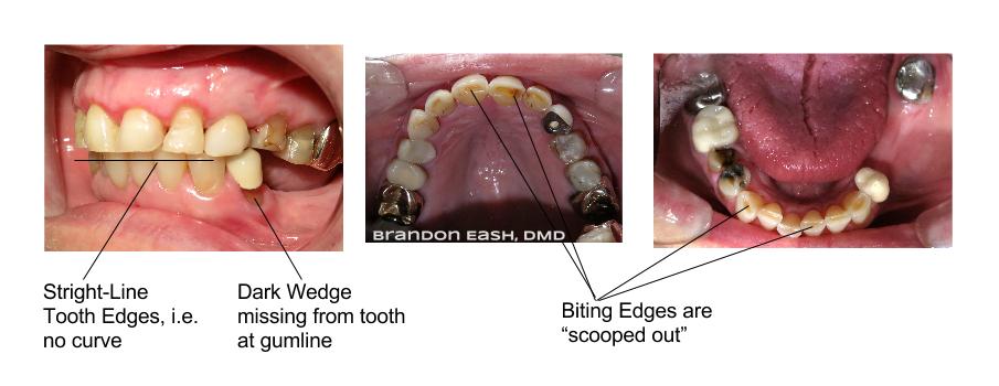 BrandonEash_DMD's tweet photo. #ToothGrinding can be very damaging to teeth.  A simple #nightguard can save $1000's worth of irreversible damage. https://t.co/kkgqGoCdg2