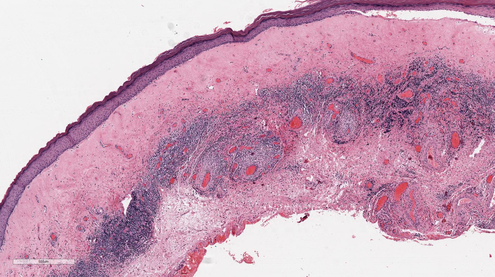 Lichen Sclerosis Histology