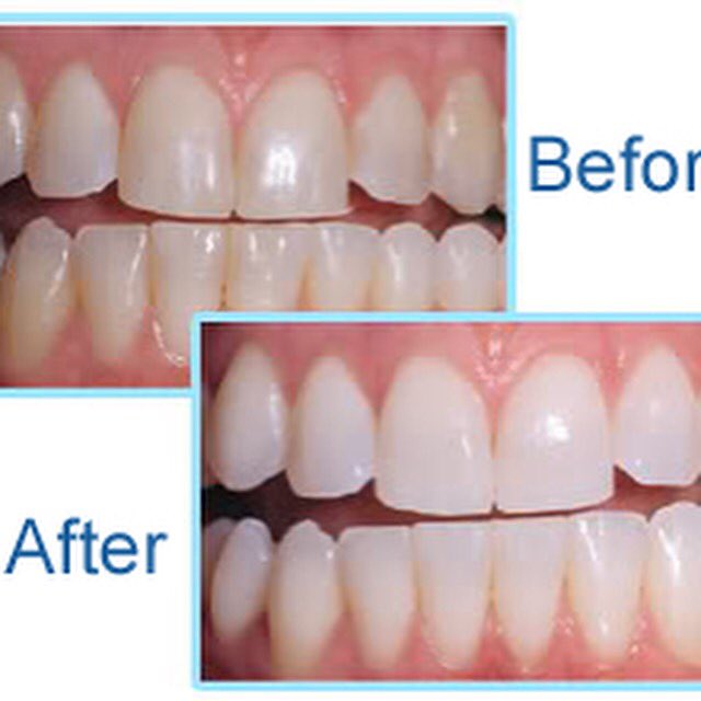 CHF 350 teeth whitening. Expires 30 April. Dr Bonsall, Basel. Book online: DrBonsall.ch or  061 271 0604