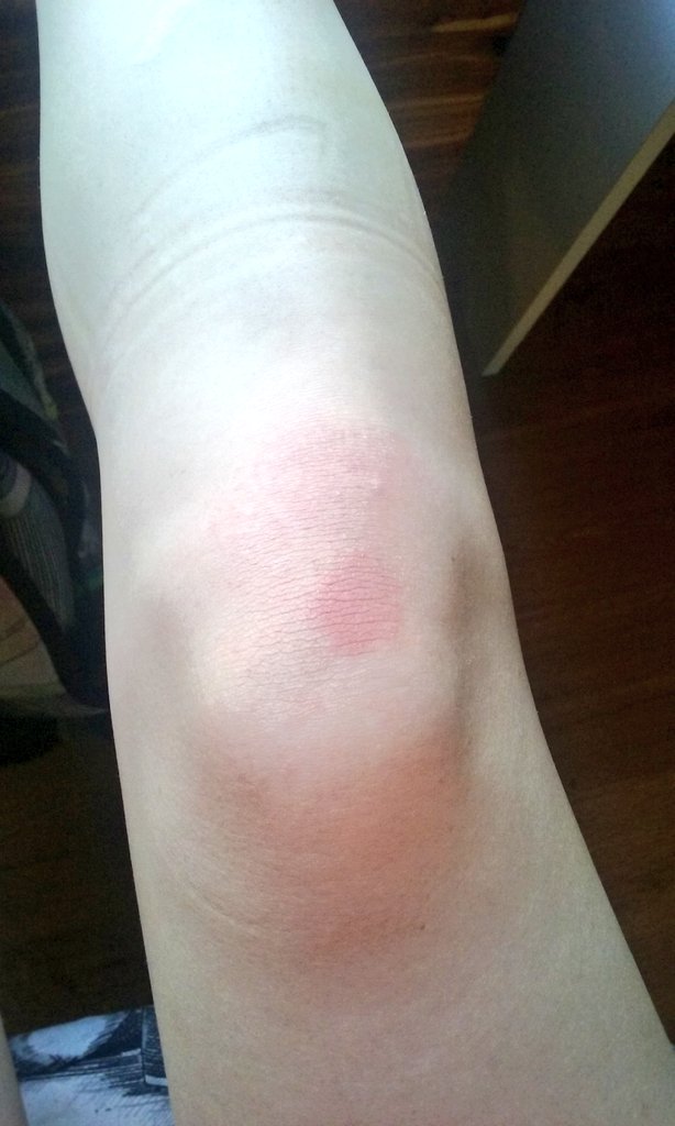 Makennactp's tweet photo. My knee will forever look like this during track season. #StarterBlocks #RunnerProbs https://t.co/XUlZqLzi2W