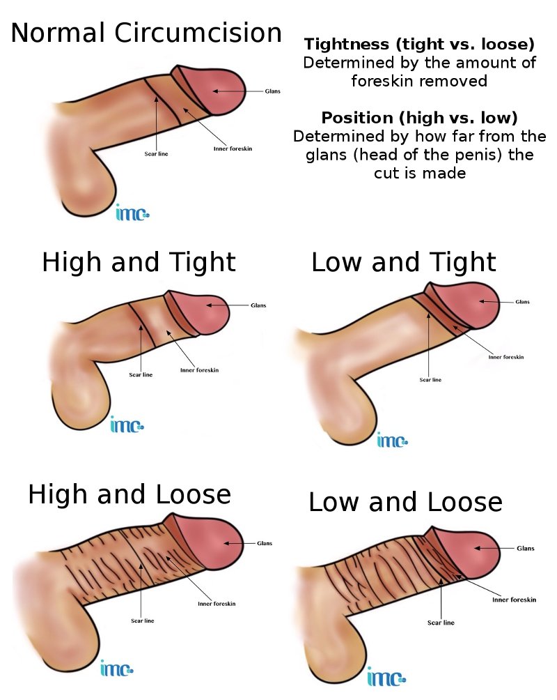 Foreskin Problems And Circumcision