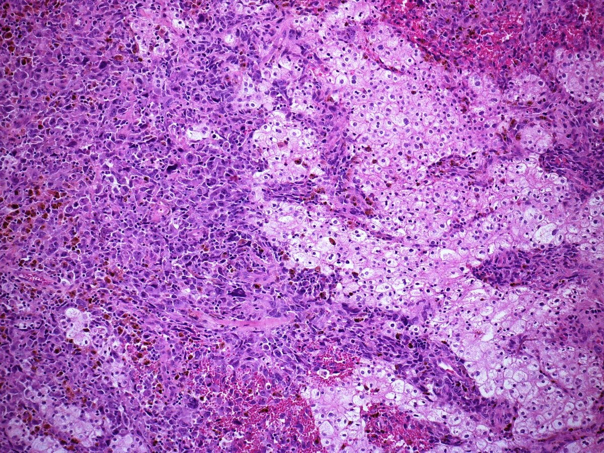 DrAndrewRyan's tweet photo. Any twitter (uro)pathologists seen ChRCC grow/act like this #verystrange #dedifferentiated #gupath #opinionswelcome https://t.co/SN90bjOLRB