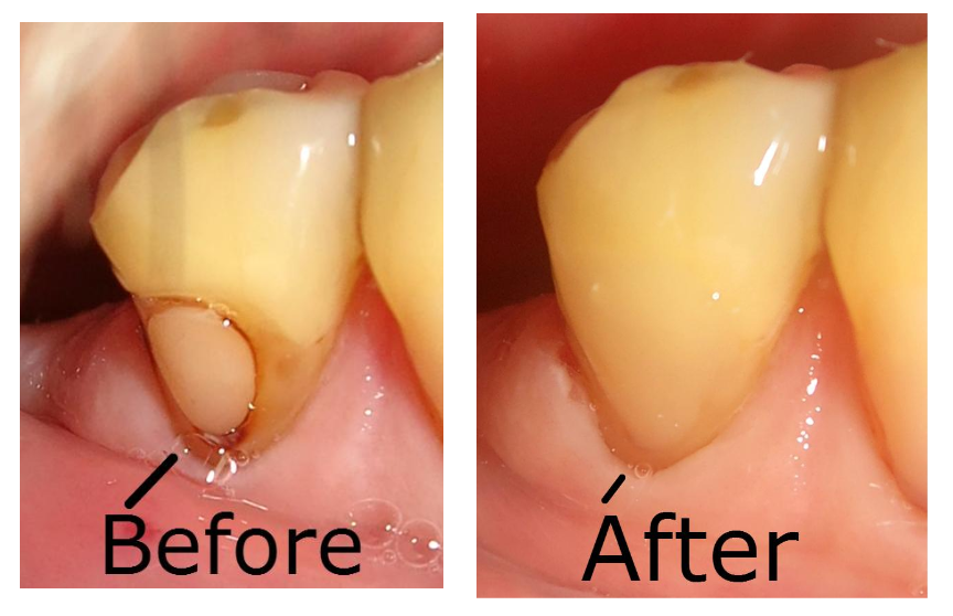 BrandonEash_DMD's tweet photo. Fixing a #cavity can also fix the #esthetics of a smile. Modern restorative materials are availabe - I use them. https://t.co/HlJ5jsVF4A