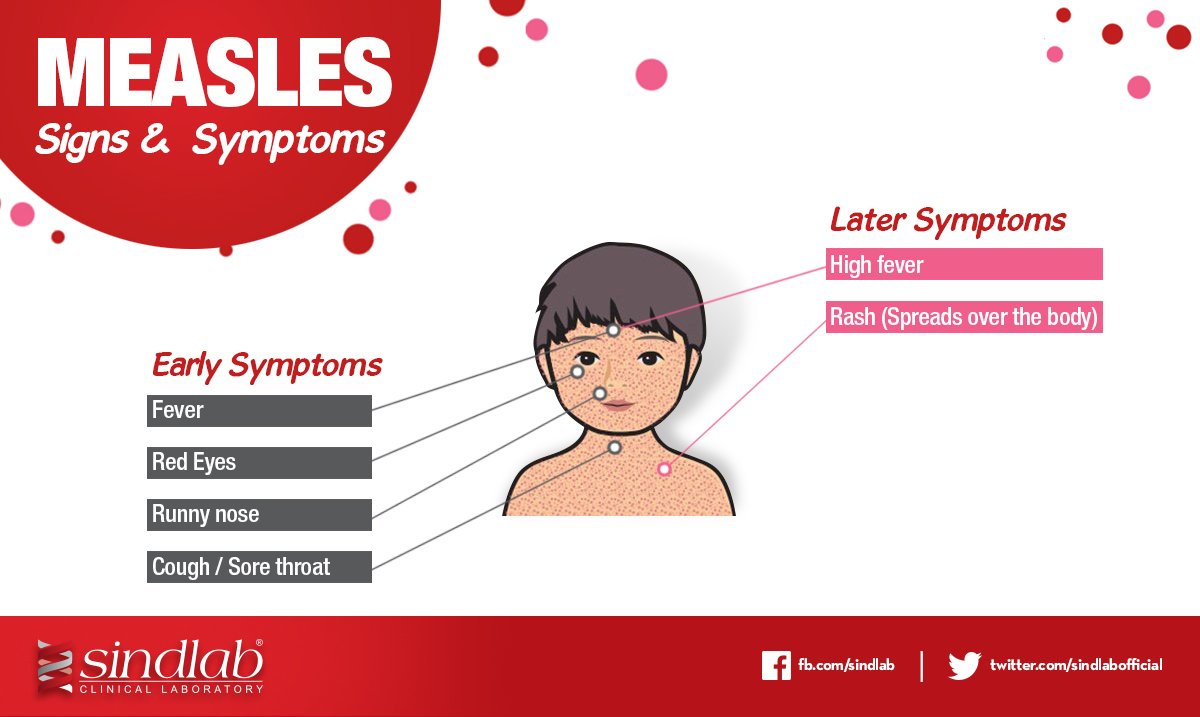 sindlabofficial's tweet photo. All parents are advised to seek medical advice for their children if they see any symptoms of #Measles. #Sindlab https://t.co/8OHyRkHUL4