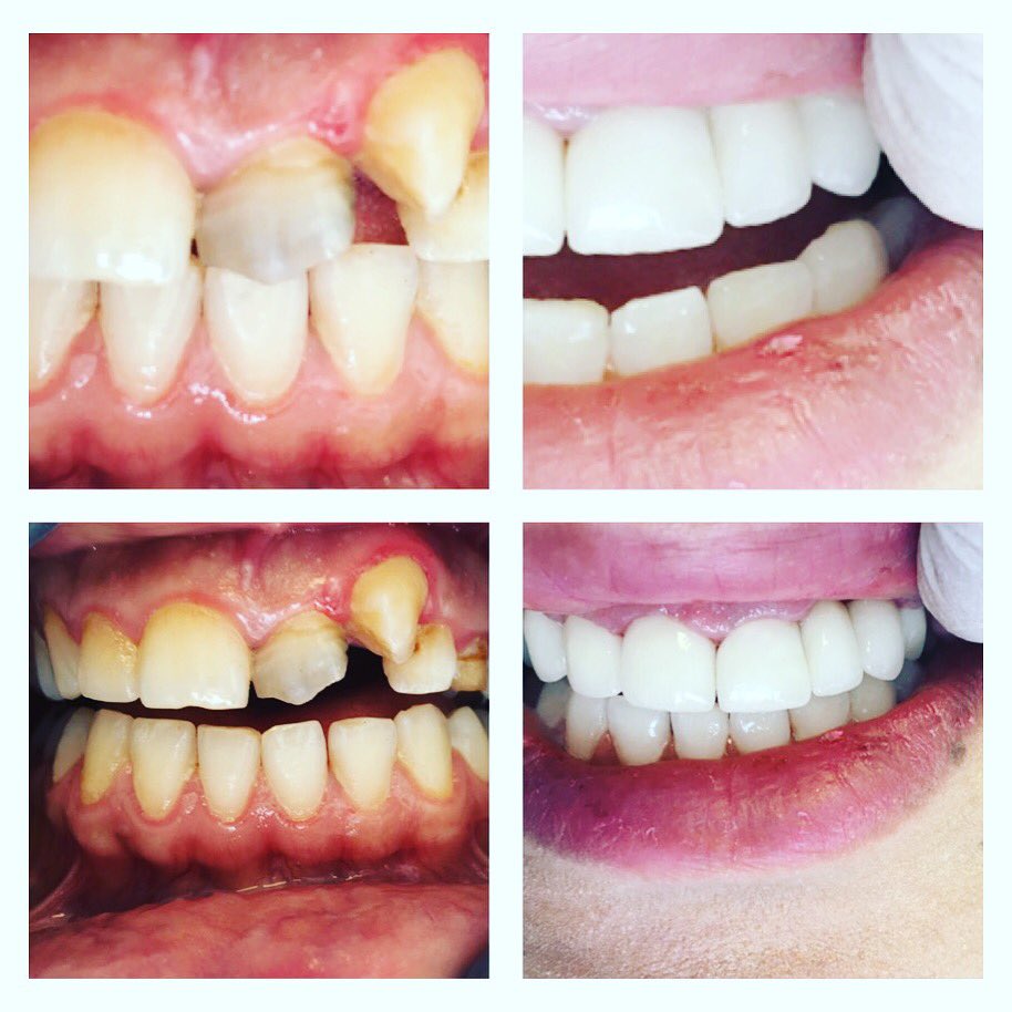 Dt. Derya Perçin #çaprazdiş #zirkonyum #beyazdiş #mutluhasta #dentist #dentakraft