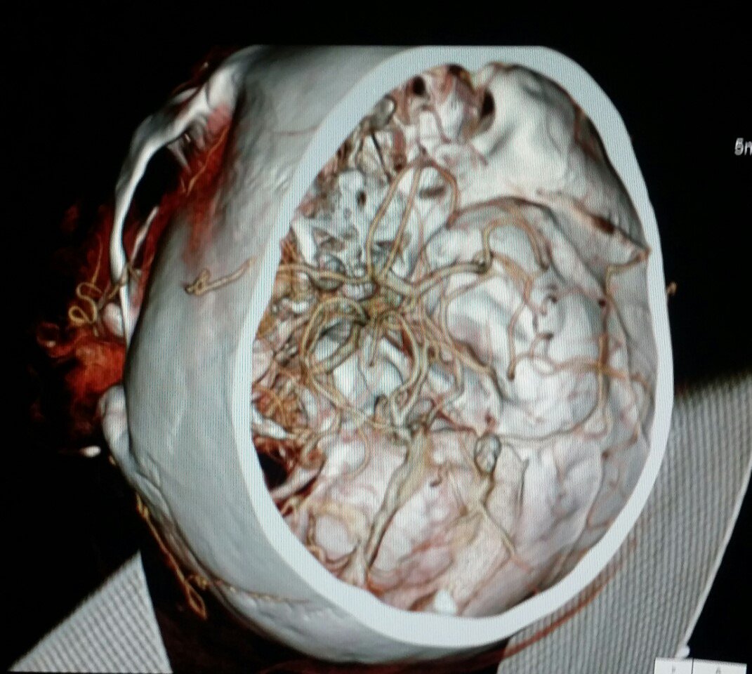 NBRadiologists's tweet photo. #Normal #multidetector #CT of the #arteries of #brain #patient w/ #headache. #radiologist #radiology #pain #trauma https://t.co/urRiQpA60W