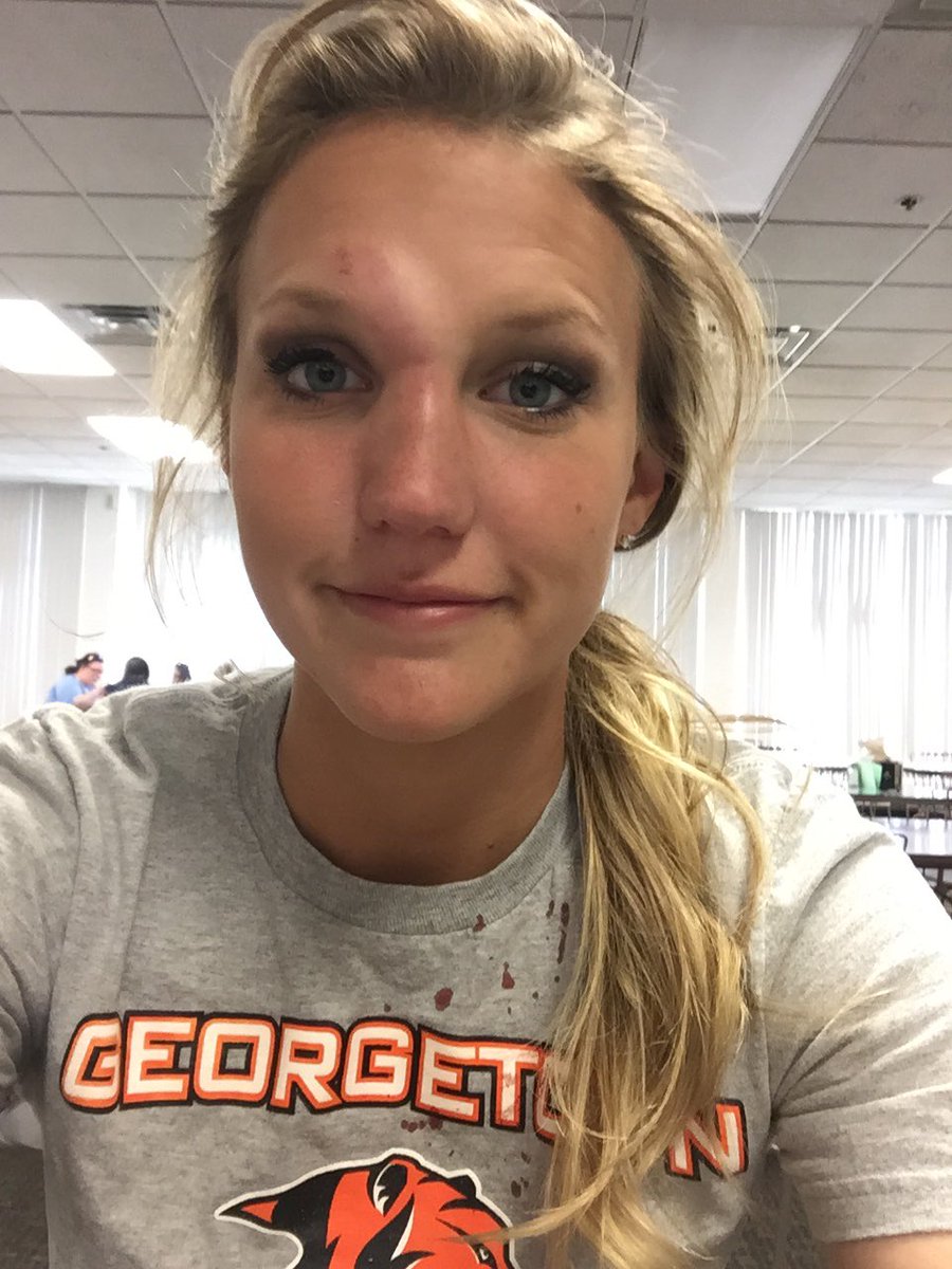 ChelsaeOsborn's tweet photo. Just in case you were wondering how my week has been. #softballprobs https://t.co/PryApCYq0s