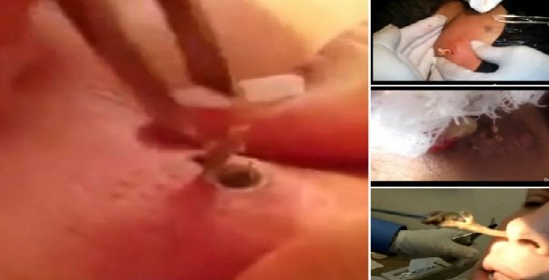 EvylFernandes's tweet photo. MÉDICO REMOVE ESPINHA QUE CRESCEU POR 10 ANOS EM PACIENTE!
https://t.co/WXnLohh4BE Dia Mundial da Saúde https://t.co/iqJMz6CDDD
