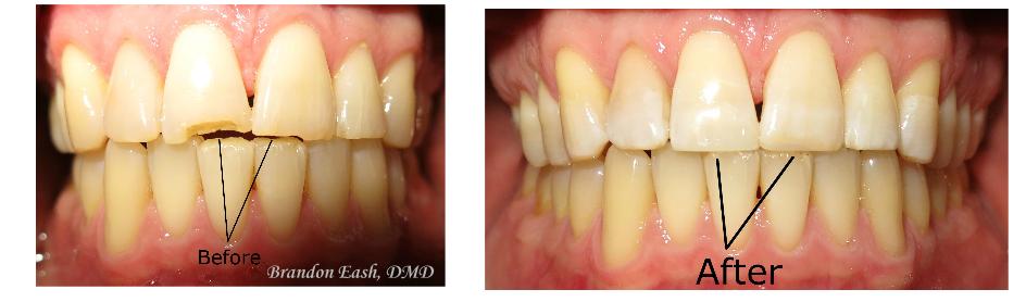 BrandonEash_DMD's tweet photo. #chippedTooth? If the chip is small, chances are you dentist can fix it up in one visit. Pictured is a recent case. https://t.co/5jAhgwXv2K